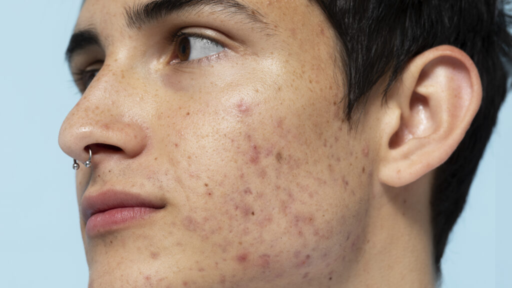 Hombre joven en una vista lateral con lesiones ne la piel causadas por el acné.